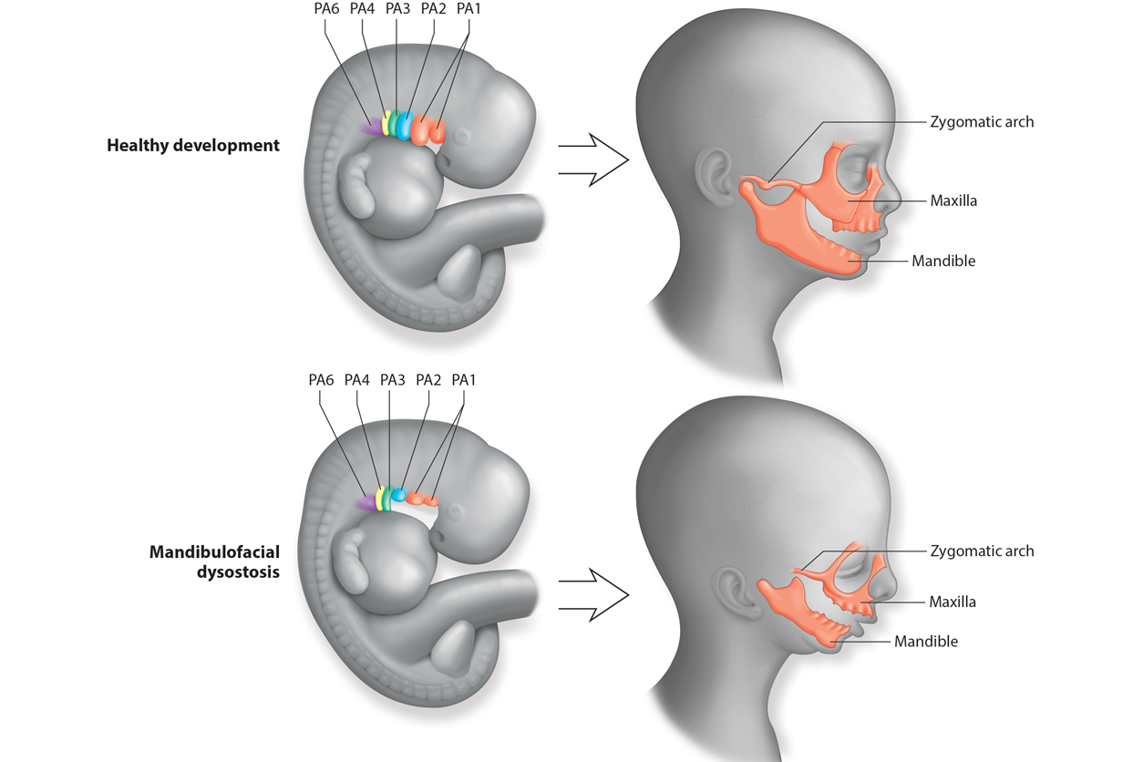healthy fetal development leading to familiar facial structures and mandibulofacial dysostosis development leading to abnormal facial structures