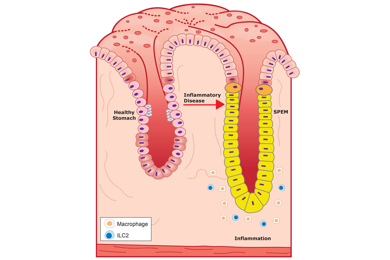 healthy and diseased stomach pit