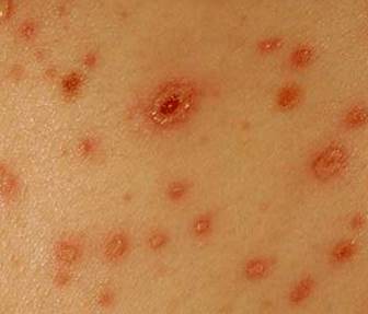 chigger bites